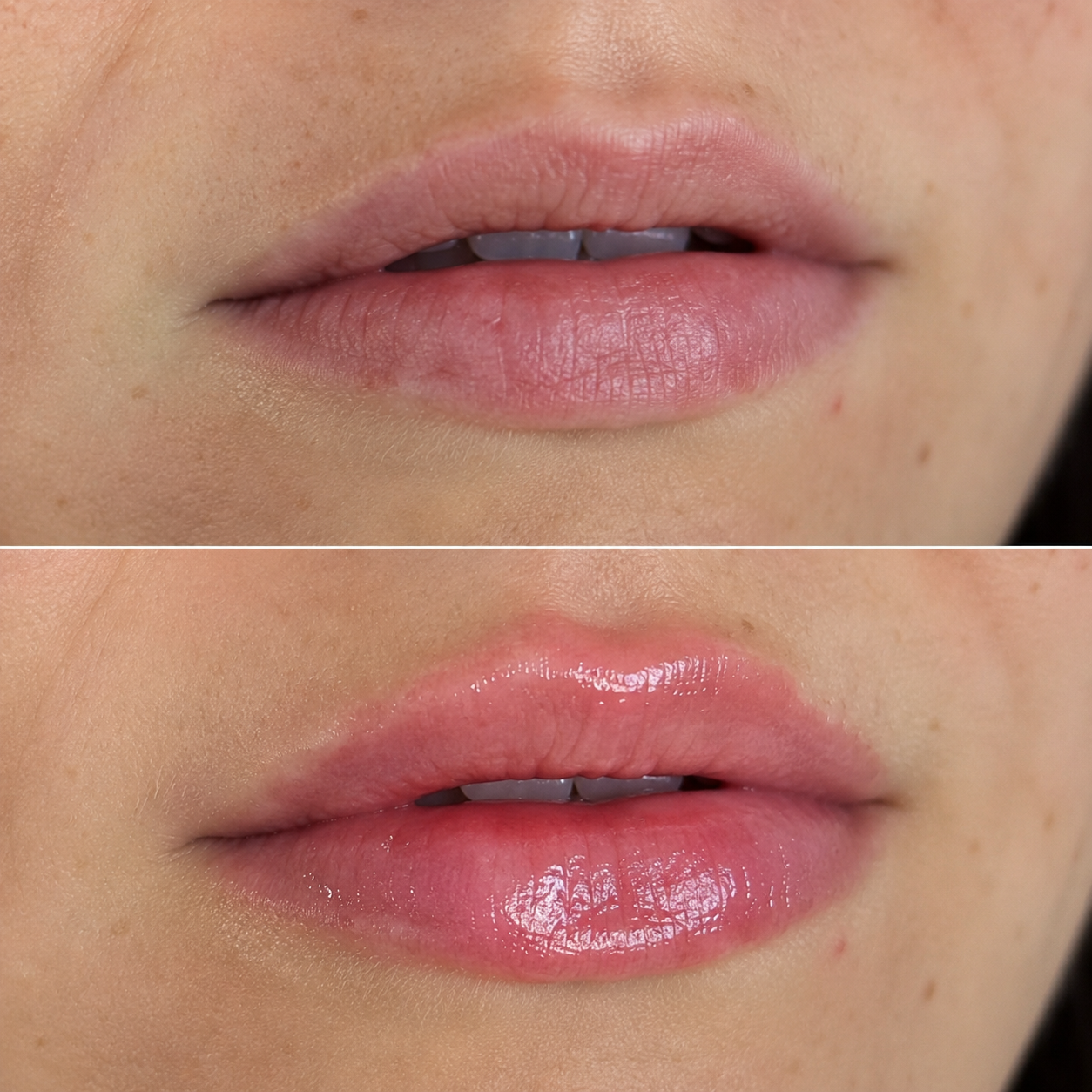 Bacio - Microneedling