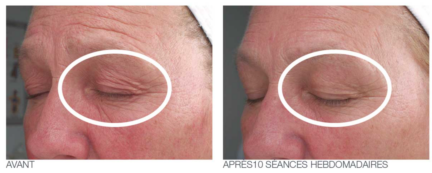 Soin lifting visage MPR toroïdal