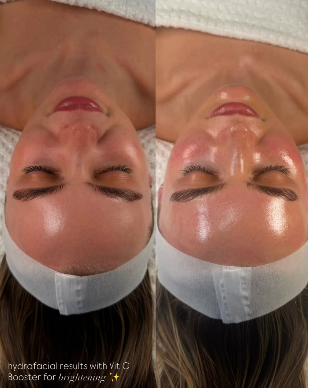 Hydrafacial